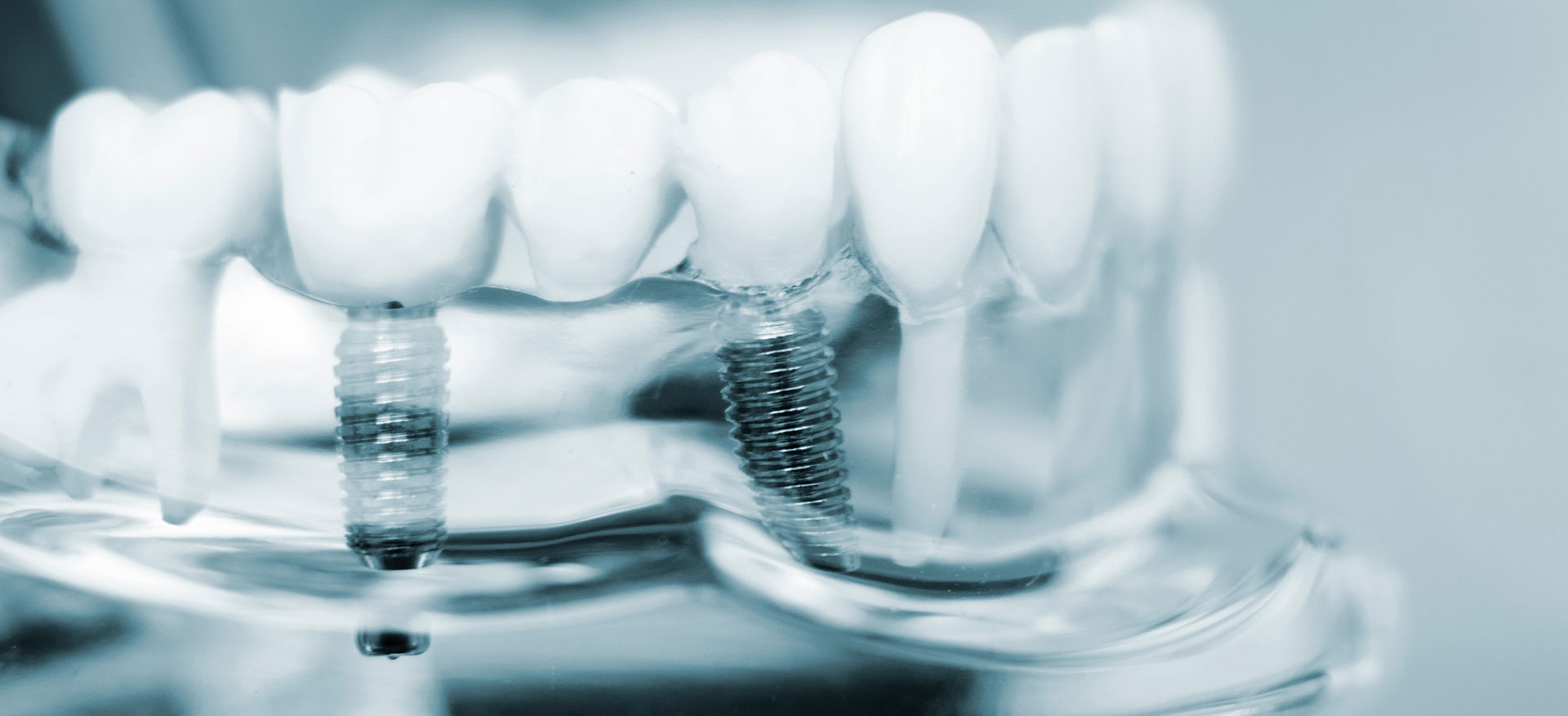 Woodmere Dental Implants
