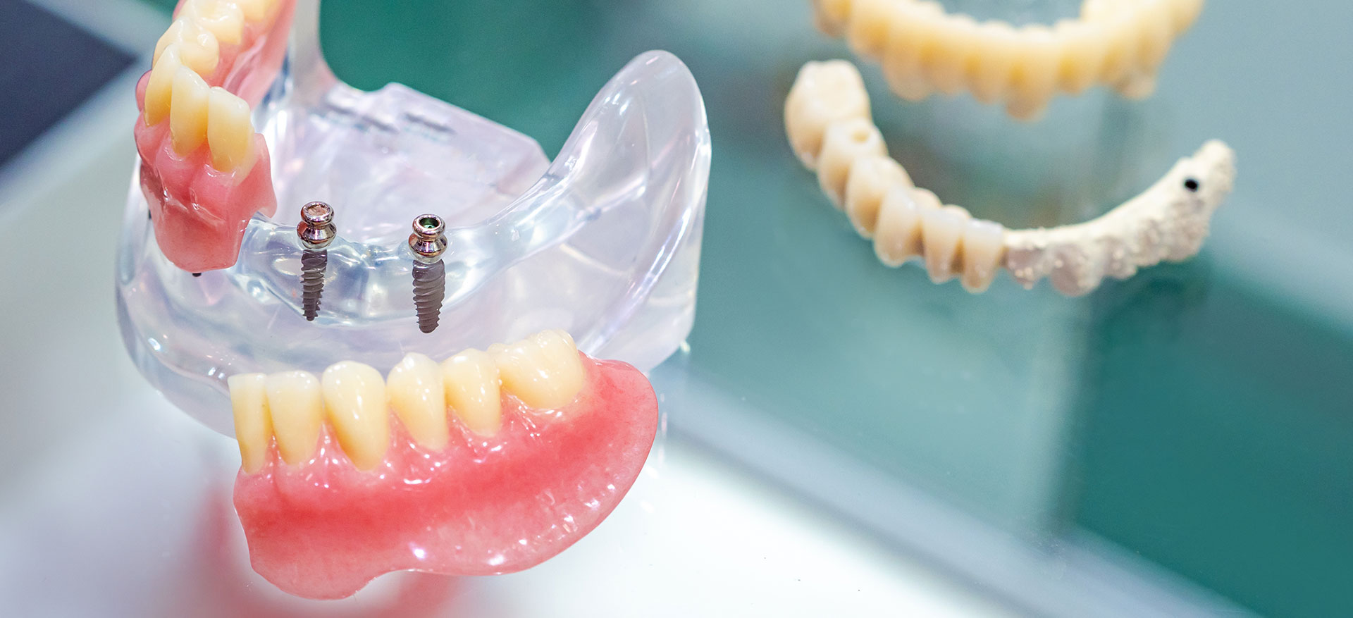 Mini Implants in Woodmere